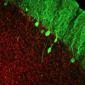 Diagnosing essential tremor after death helps families learn risk