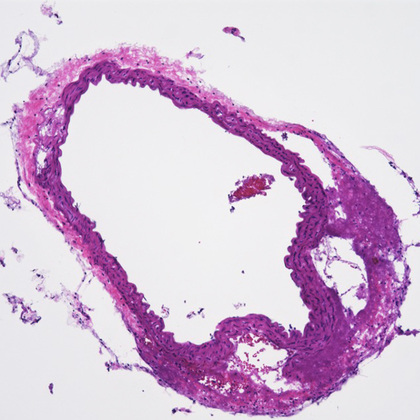 Gene editing treats smooth muscle disease in preclinical model