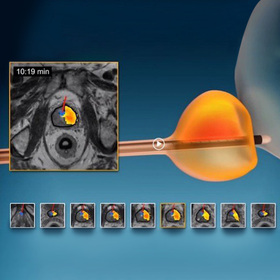 UT Southwestern pioneers new minimally invasive treatment for prostate cancer