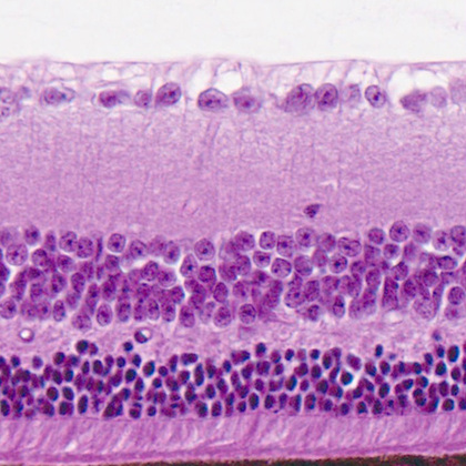 Study links female sex hormones to progression of eye disease