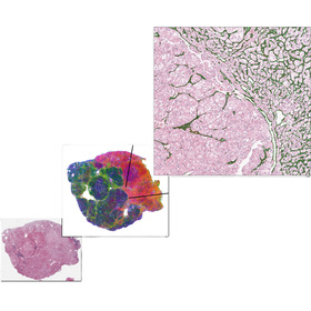 Artificial intelligence predicts kidney cancer therapy response