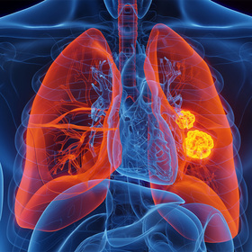 FDA-designated orphan drug could increase radiation efficacy in lung cancer