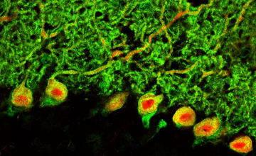 Cerebellar Disorders