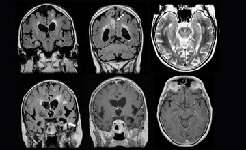 autoimmune neuroimmunology clinic