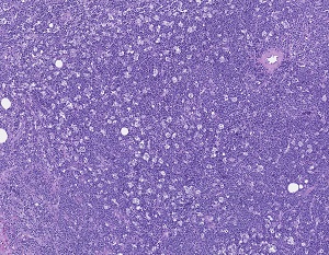 Hematopathology Photo