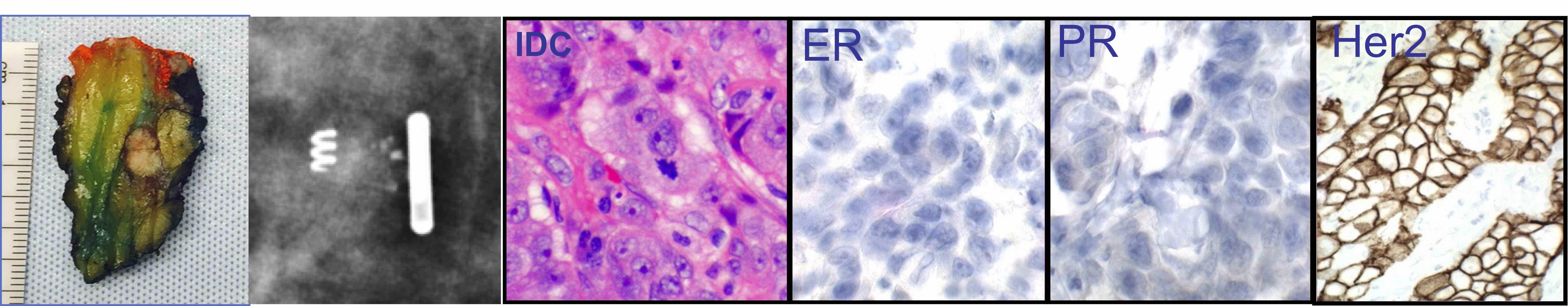 Breast Gross, Histology, and IHC Breast Gross, Histology, and IHC