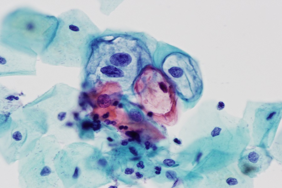 LSIL Pap Smear 40x LSIL Pap Smear 40x