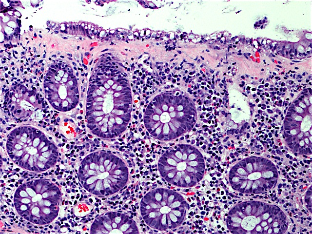 Collagenous Colitis Collagenous Colitis