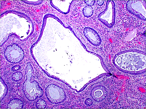 Juvenile Polyp Juvenile Polyp