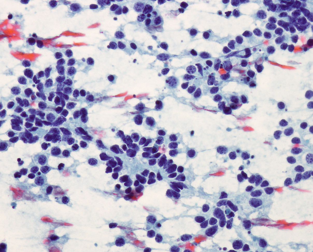 Neuroblastoma, Papanicolaou Stain, 20X Neuroblastoma, Papanicolaou Stain, 20X