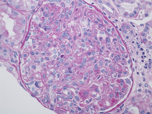Cryoglobulinemia-associated membranoproliferative glomerulonephritit, PAS stain x400 =