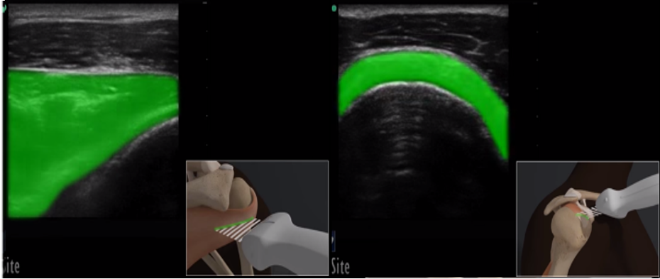 Illustrations of rotator cuff region of interests within short-axis supraspinatus tendon (A) and long-axis infraspinatus tendon (B). Lin figure 2