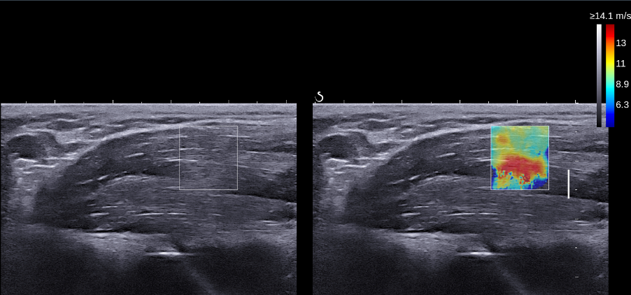 Representative (left) B-mode and (right) shear wave elastography imaging for in-vivo and dynamic evaluation of spatial-temporal tissue properties. Lin figure 3
