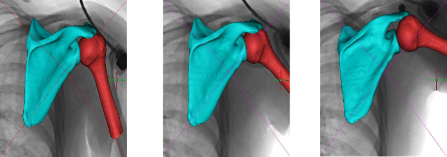 3D reconstructed models of glenohumeral joint kinematics with model-based tracking and contour registration to the dynamic biplane fluoroscopy system. Lin figure 1