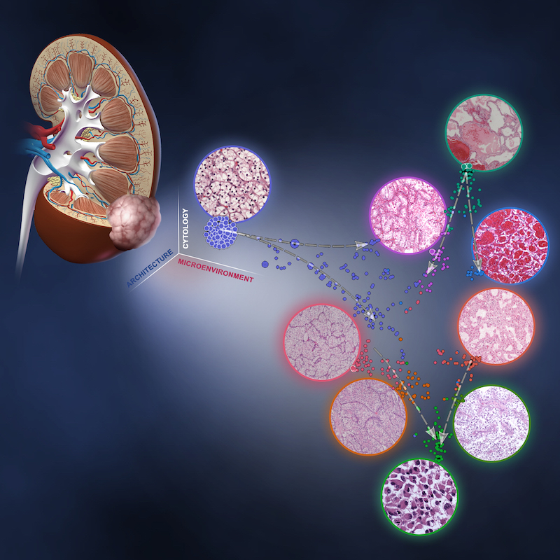 Illustration of the nine distinct patterns of ccRCC morphology based on extensive analysis of tumor architecture, cytology, and microenvironment Illustration of the nine distinct patterns of ccRCC morphology based on extensive analysis of tumor architecture, cytology, and microenvironment