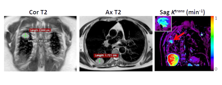 Above are images of a tumor in the lung Scans of a tumor in the lung