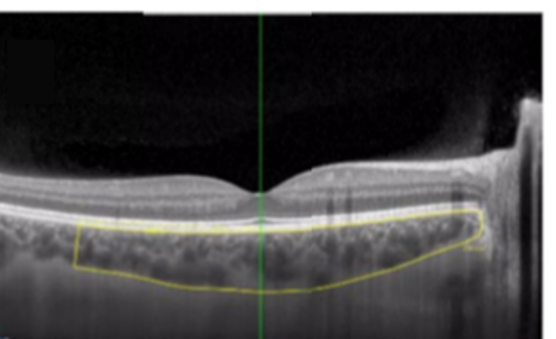 Choroid Photo of The choroid, a thin layer in the middle of the eyeball’s wall
