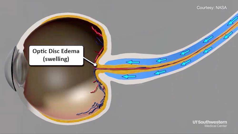 Eyeswelling Photo of Eye swelling