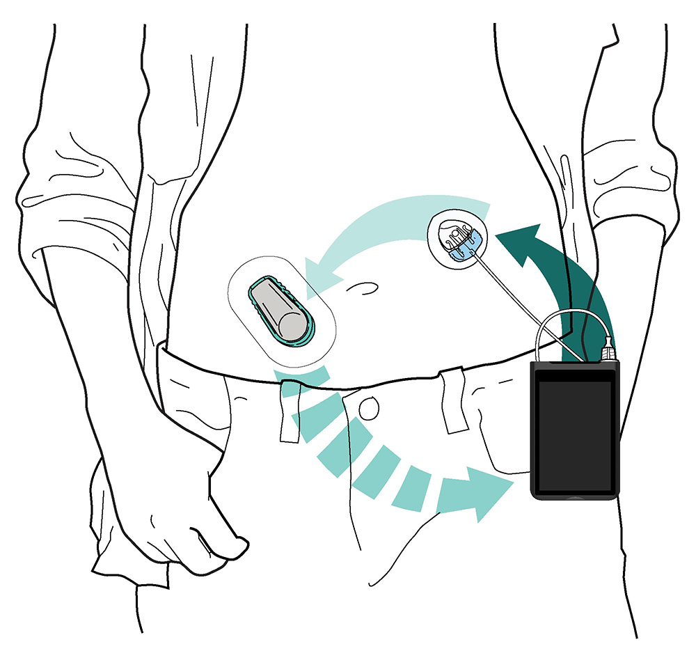 iLet Bionic Pancreas