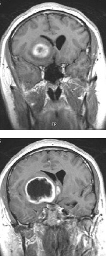 The spread of glioblastoma