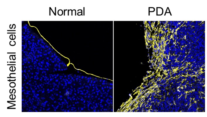 Tracing the fate of mesothelial cells during PDA progression using the lineage tracing technique.