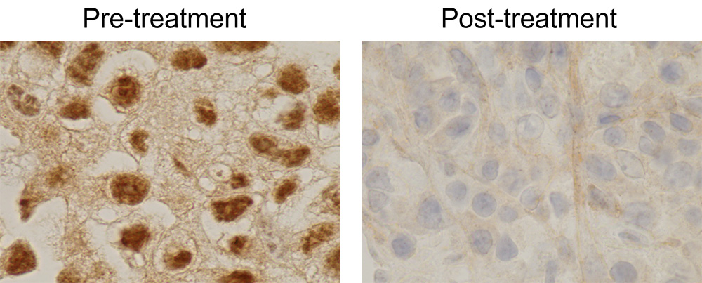 Patient tumor biopsies.