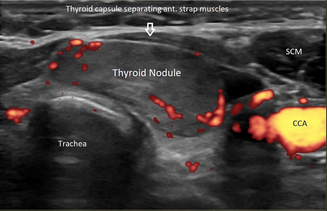 An ultrasound picture of the thyroid nodule
