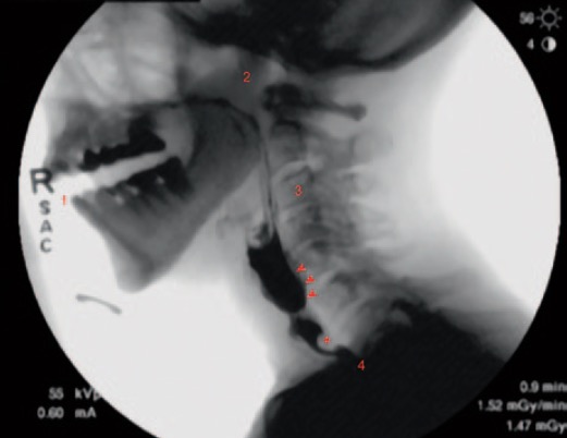 Image of a video fluoroscopic swallow study.