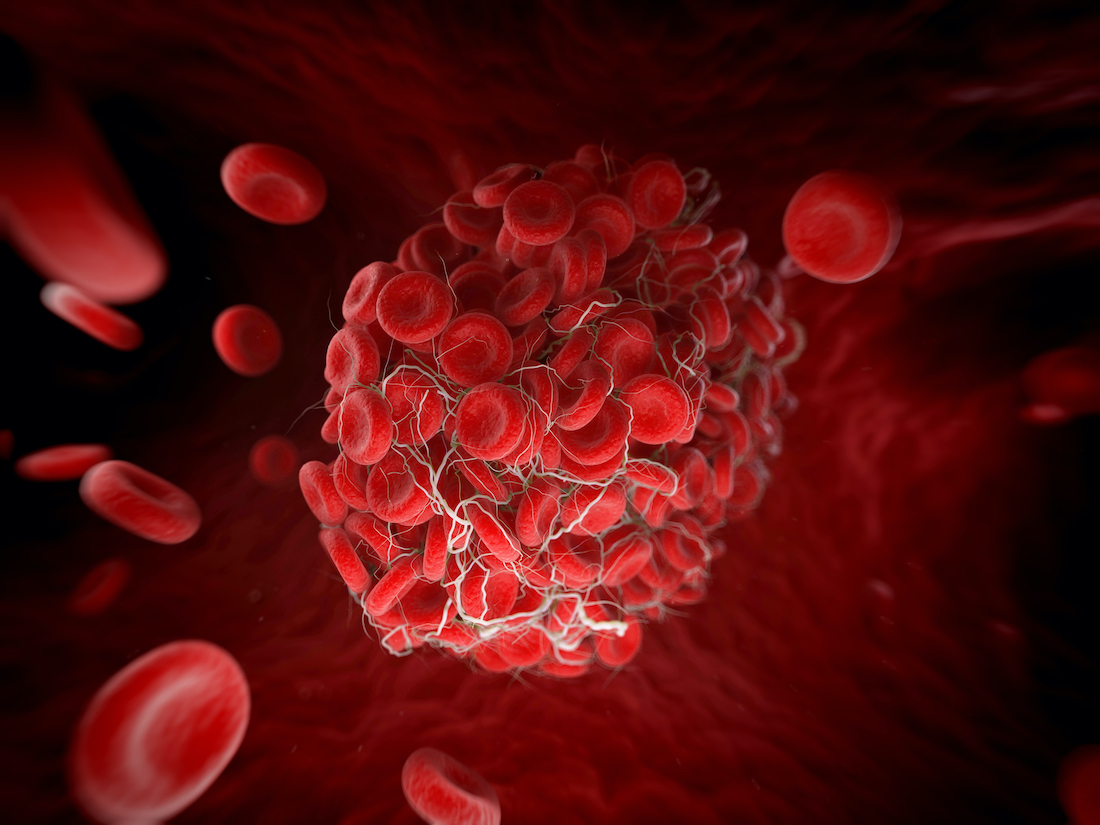 Blood clot, computer artwork.