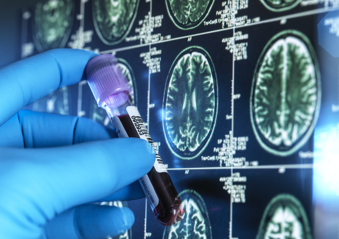 The study by researchers at UT Southwestern is believed to be the first to computationally model mechanisms of protein misfolding that are associated with neurodegenerative diseases.