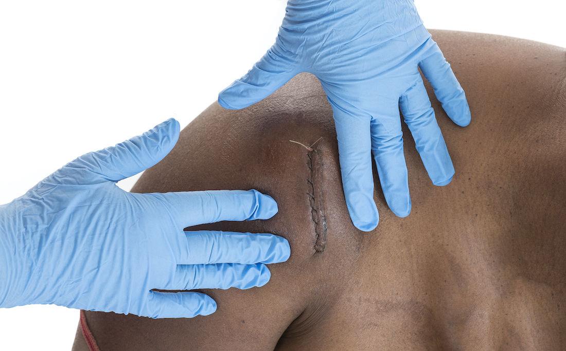 Nurse palping an Hematoma on shoulder under scars