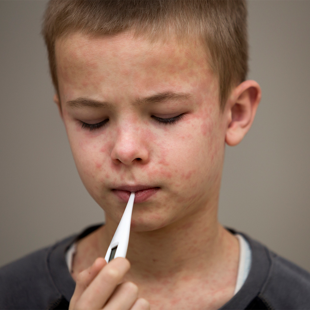 A boy with measles