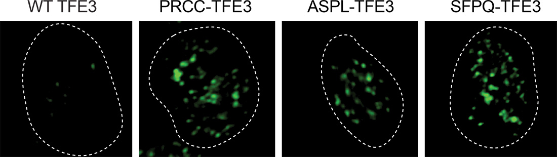 Nuclei of cells from tumors of kidney cancer patients harboring wildtype (WT) TFE3