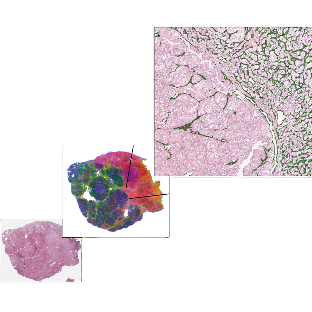Histopathologic slide image of kidney cancer tissue