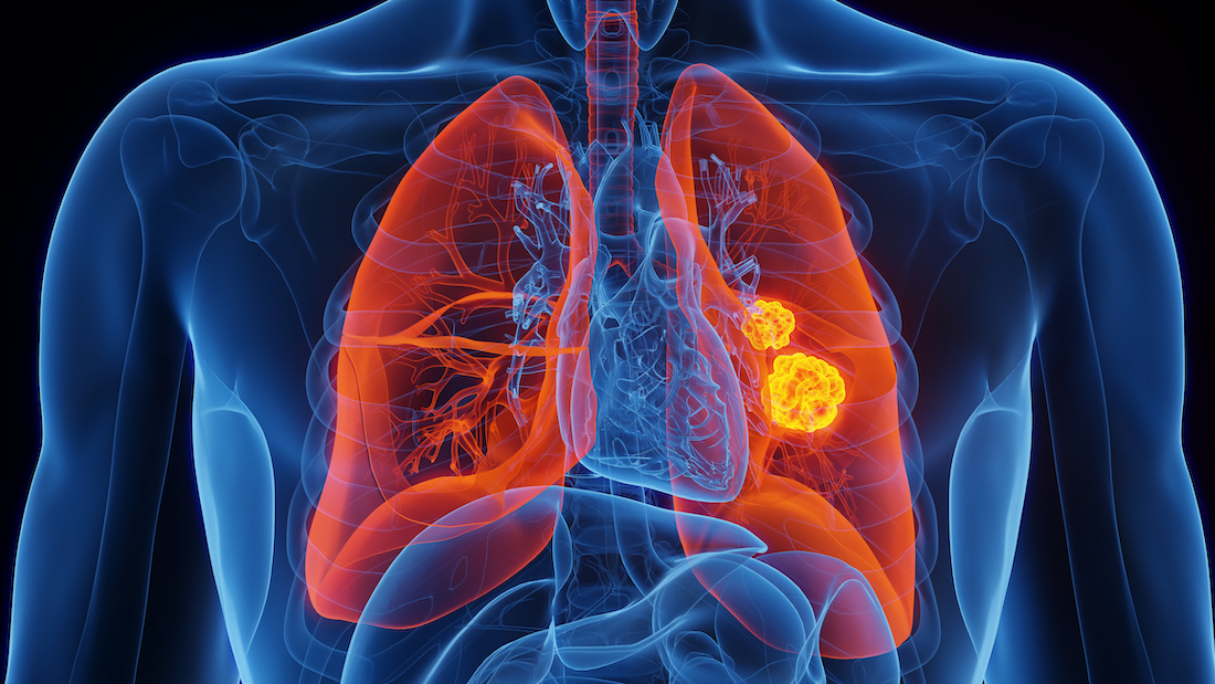 Lung cancer, illustration