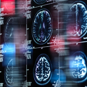 Taking Aim at Alzheimer’s